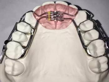 Dental Frankel Orthodontic Appliance From MYY Dental Lab
