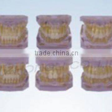 Orthodontic classification model ( two-color , a set of 10 groups )/dental orthodontic modelsmodels