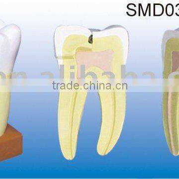 maxillary three roots caries(2 parts)