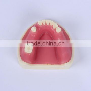 New Type Good Quality Dental Implant Model with teeth