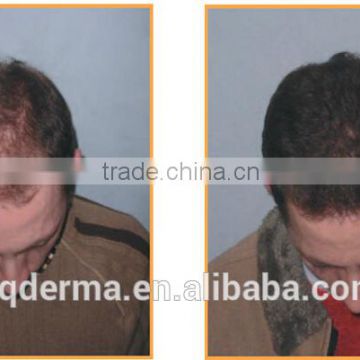 2015 best 650nm low level hair loss maser treatment