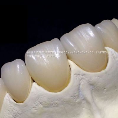 Dental Crown and Dental Bridge - Metal / Pfm / Ceramic Bridges