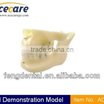 Hot sale and high quality implant model with orthodontics AC-P13
