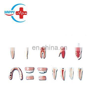 HC-S412 Dental lesion series model/Dental Diseases Model, Lesion Teeth model