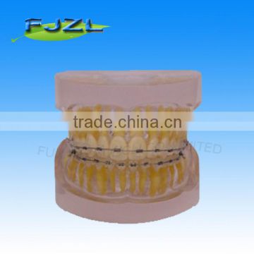 orthodontic teeth model(Transparent model , normal tooth, invisible brackets),dental orthodontic models