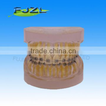 orthodontic teeth model(Transparent model , normal tooth, common brackets)/dental orthodontic models