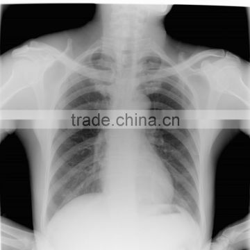 china digital mammography & medical ct film & x ray fim for mri equipment