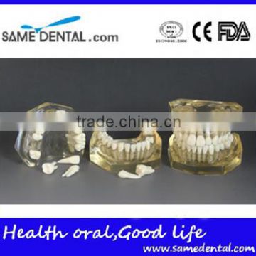 Dental detachable transparent dentition model DEA-47
