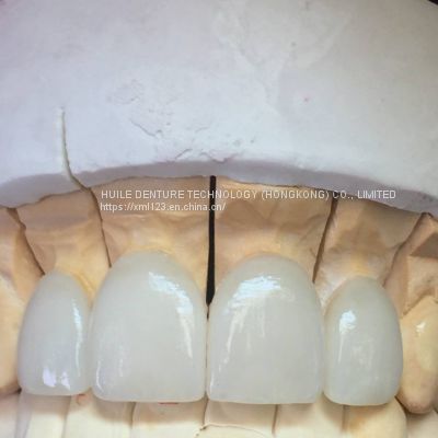 Crowns/ Metal-Free Dental Crowns
