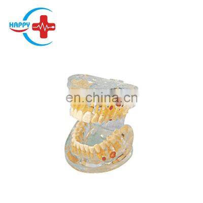 HC-S408 Best Dental teaching model,Pathological Tooth Transparent Model /dental model tooth for teaching