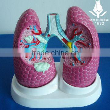 Pathological model of bronchi pulmonary