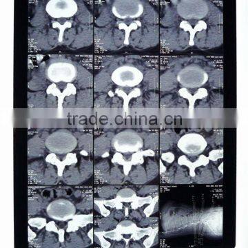 Imaging medical ray film,digital x-ray cr,medical equipment used in hospital