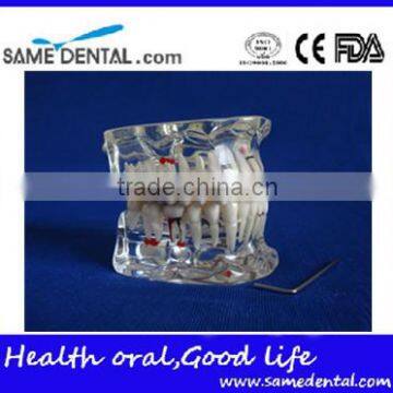 Dental adult pathological dentition model DEA-48 teeth model teaching demonstration