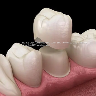 Durable FDA All-Ceramic Dental Crown Veneer Inlay Onlay Similar