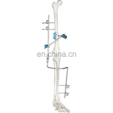 Guaranteed Quality Medical Bone Surgery Hoffmann Knee Joint External Fixator Orthopedic Surgcal Instruments