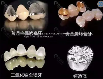 High Strength Yellow Gold Porcelain Dental Crown PFM Ceramic Crown