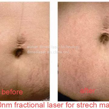 1550nm Erbium Glass Laser Treatment Machine For Wrinkles / Stretch Marks Removal