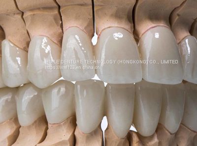 Aesthetic Dental All Porcelain IPS Emax Bridge