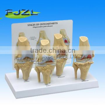 4-Stage Osteo-Arthritic Artificial Plastic Knee Joint Anatomical Model