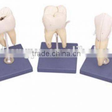 Tooth Model Series, 5 models